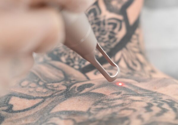 Tatueringsborttagning med Pico Laser